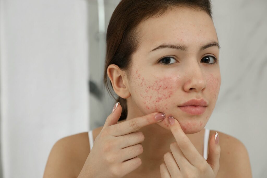 Acne Scars Vs. Pimple Marks