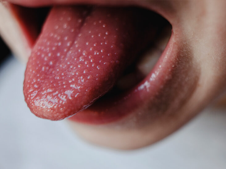 Changes in the Tongue